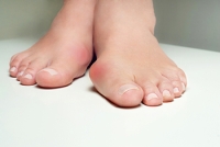 What Can Be Done About Bunions?