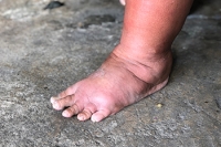 The Link Between Swollen Feet and Alcohol